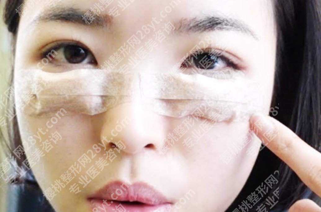 做眼袋手术有必要吗?别让它拖垮你的颜