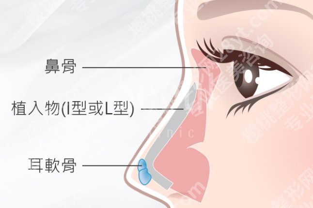 软骨隆鼻可以一辈子吗?不同医生回答不一样,软骨隆鼻寿命揭秘