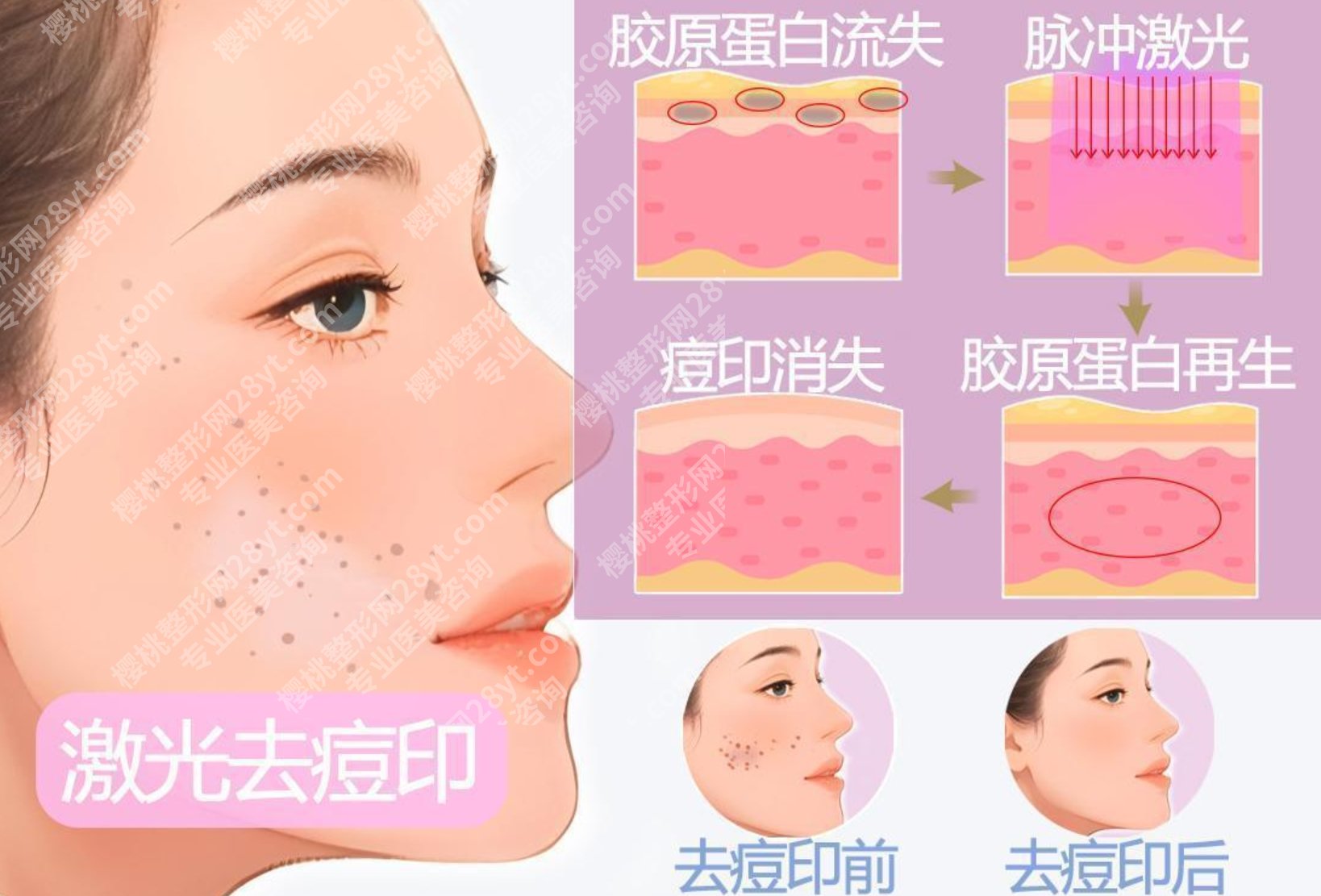 激光祛痘印有效果吗?亲身试过之后才敢说|效果比想象中靠谱