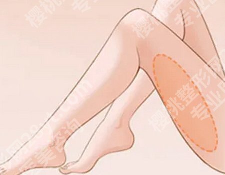 哈尔滨医大医美注射瘦腿全解析,案例见证,原理大揭秘