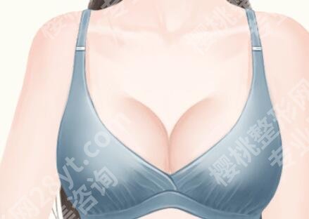 毛面假体和光面假体哪个好?核心区别分析,看完这篇不纠结