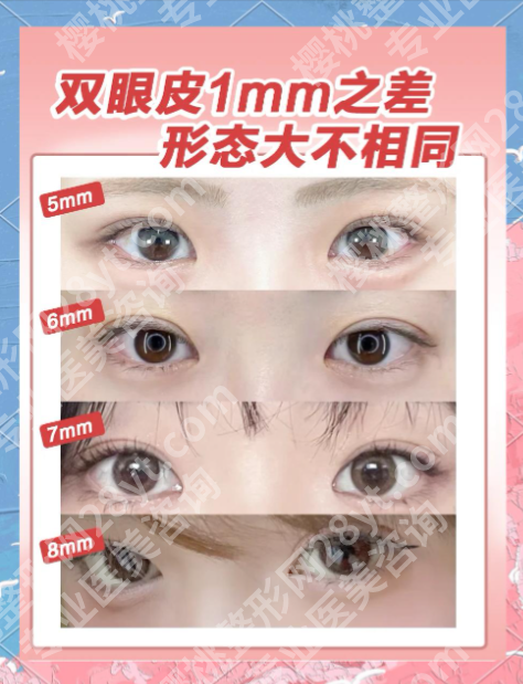 汕头附一蔡湘娜双眼皮怎么样?内附真实案例+价格表,肿眼泡宝子亲测不踩坑!