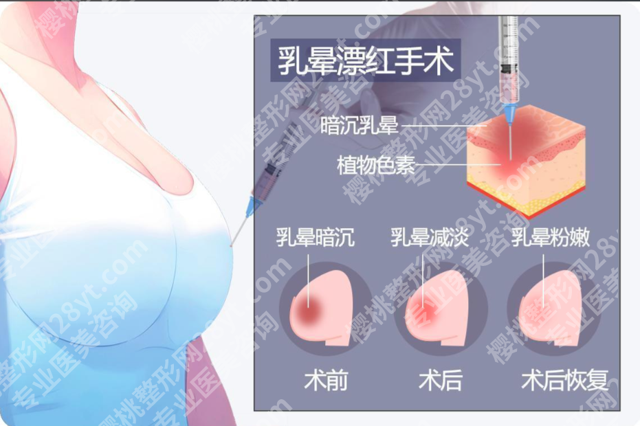 乳晕整形术要多少钱?价格背后的门道你必须知道