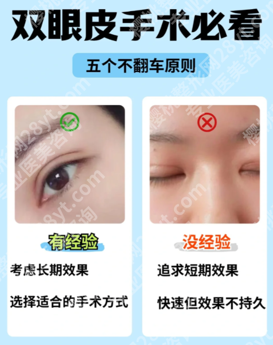 无锡二院割双眼皮全攻略:本地人等2周也要约的医生,效果到底多自然?