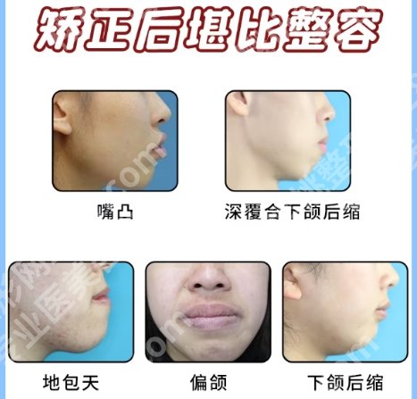 北大深圳医院牙齿美容科怎么样?医院简介|正畸案例图反馈!