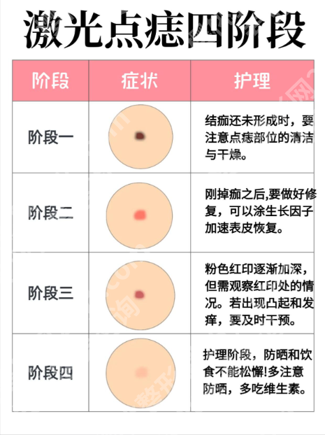 广州珠江医院美容科激光点痣好不好?2025真实案例+价格表,怕留疤的姐妹必看!