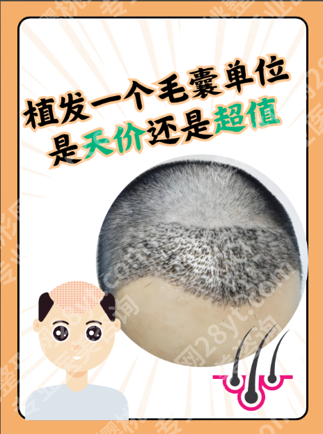 广州人民医院植发价格拆解:种2000毛囊,为啥有人花2万有人花4万?