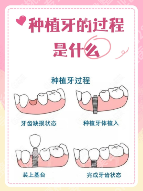 上海华东医院种植牙怎么样?2张数据表格,搞懂“种牙到底值不值”!
