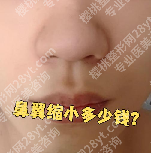 缩鼻翼手术大概要多少钱?手术方式不同,基础价差3000-8000元