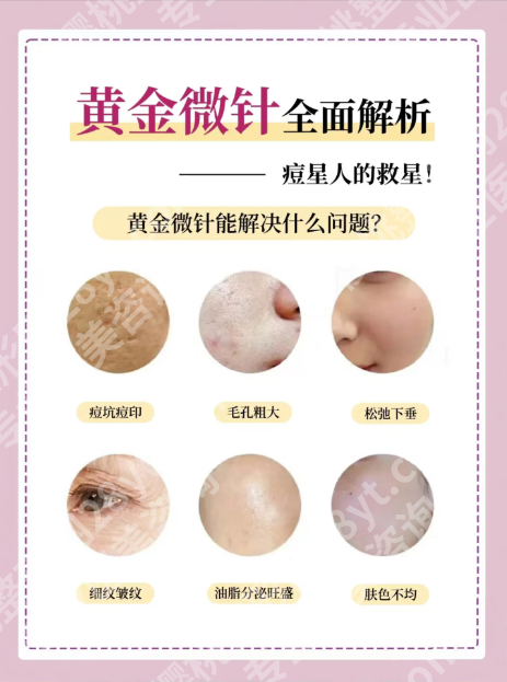 黄金微针的功效和作用:这6个皮肤问题它能解决