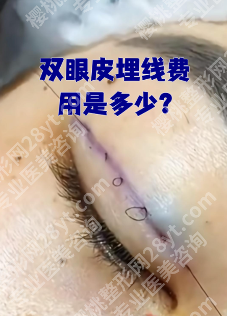 上海华山医院双眼皮埋线费用大揭秘!从3800到8000,差在哪?