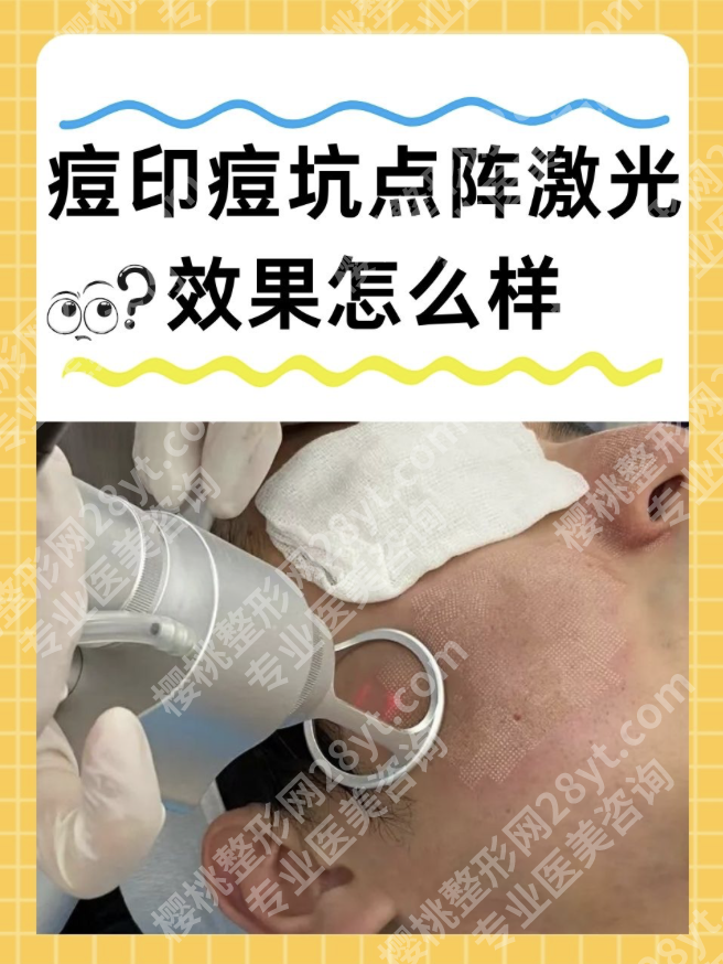 南方医院激光祛痘印:分型方案,不同痘印的精准打击策略