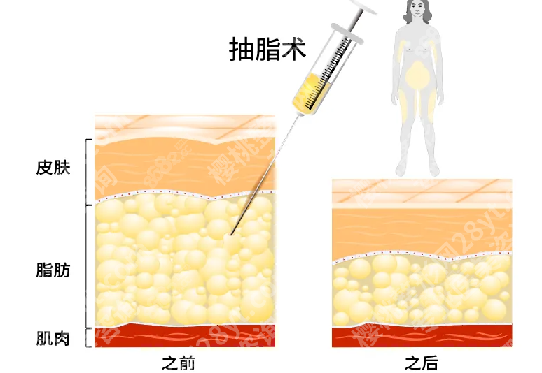深圳北大抽脂多少钱?这3个细节能省时间省钱
