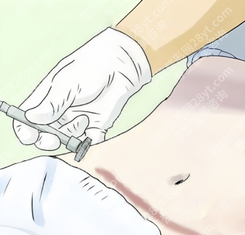 武汉腹壁整形术好的医院看这里:手术难度“天花板”,涉及4层组织修复