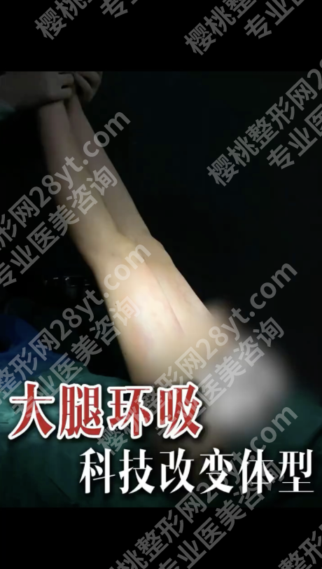 长沙做大腿环吸哪个医生好?3位名医+选医指南,闭眼抄作业!