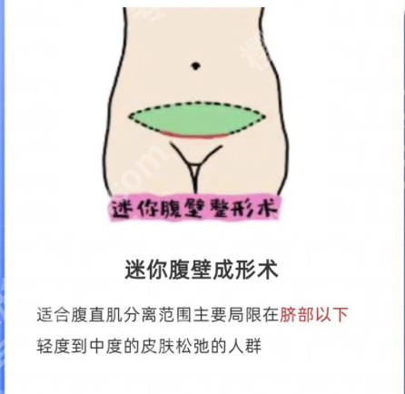 长沙腹壁整形多少钱?价目表曝光,不同方案差2万!