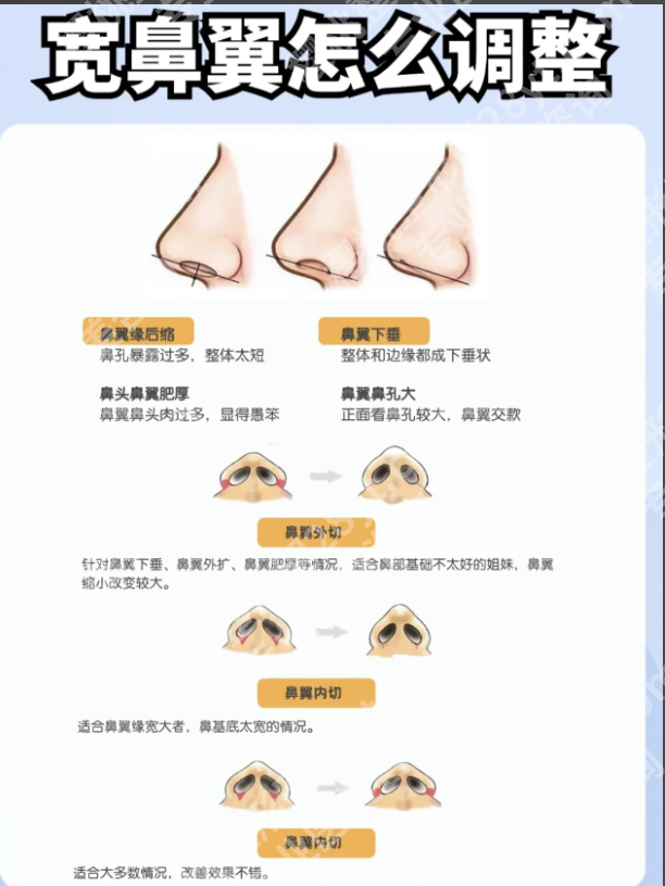 鼻翼宽大怎么?3类方案帮你缩出精致小翘鼻