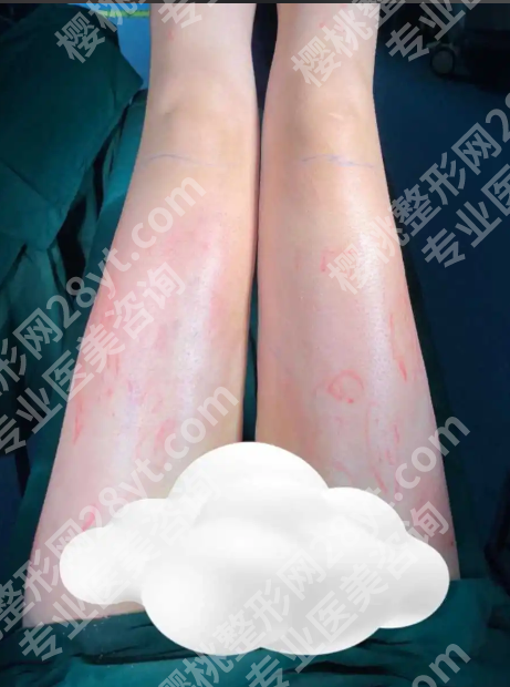 长沙大腿吸脂哪家便宜?真实低价机构测评+避坑指南,钱花对才叫值