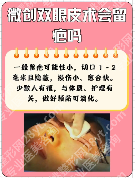 做微创双眼皮有什么危害?两张表格帮你看清风险与安全