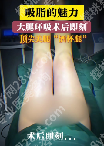 杭州大腿吸脂手术医院:术式是关键,3种腿型对应3种方案