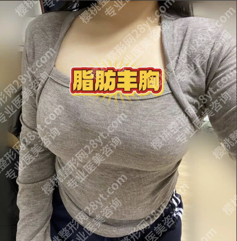 杭州自体脂肪丰胸三甲医院选哪家?3家特色机构+真实案例(附技术亮点)