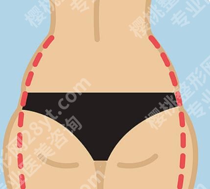 妈妈臀抽脂和大腿哪个疼?附真实痛感测评来了