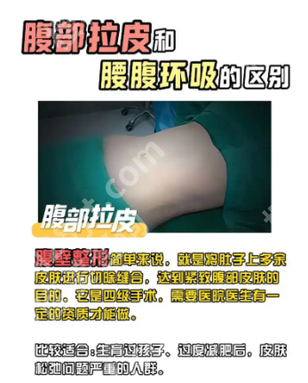 腰腹环吸和腹壁整形术有什么区别?90%的人分不清,一篇讲透核心区别