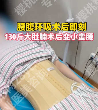 腰腹环吸的疤痕在哪里?2025实测指南+4类案例+避坑攻略