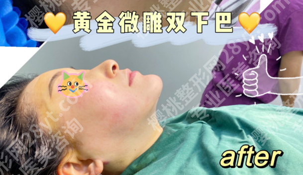 下巴黄金微雕一般多少钱?2025价格表+避坑指南,附真实案例拆解