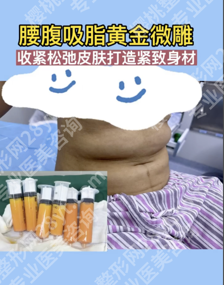 腹部黄金微雕包括吸脂吗?一篇讲透核心逻辑与实操要点