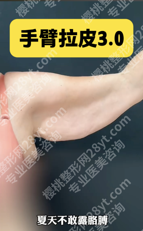 手臂拉皮腋下切口多久愈合?愈合周期+护理干货,藏住疤痕还不影响抬胳膊