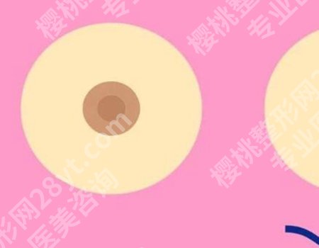做乳晕缩小手术的利弊在哪?详细利弊这里有