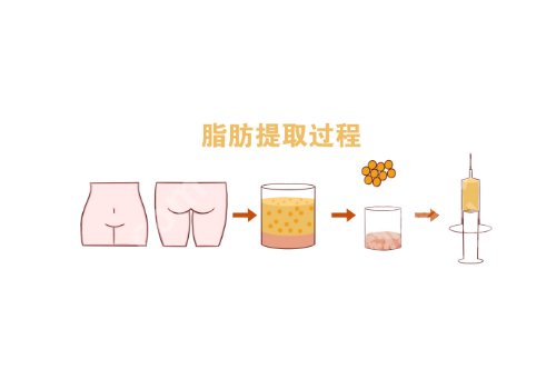 上海九医院脂肪填充价格公开!经典案例赏析、术后小贴士提前了解