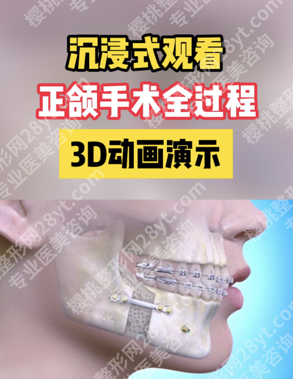 华西正颌手术费用全解析:2026新收费标准+花费明细