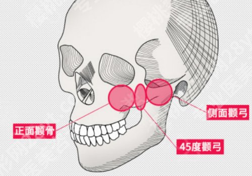 北京协和医院做下颌角多少钱? 3w元起,附人气医生+网友点评