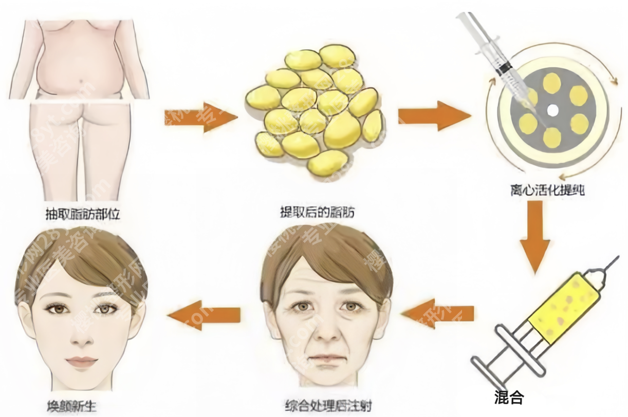 北京三甲医院脂肪填充全攻略:安全塑美,自然焕新不踩坑