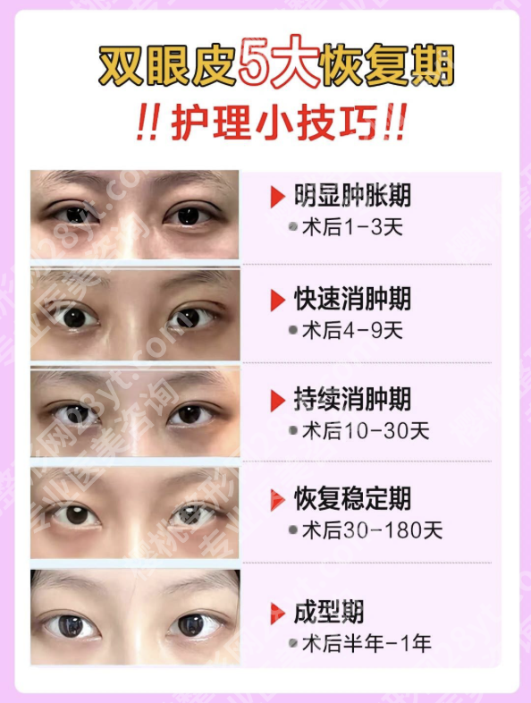 深圳北大医院割双眼皮怎么样?医生、价格、案例全揭秘
