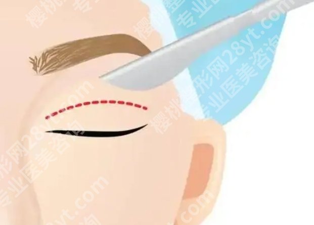 南方医院割双眼皮价格贵不贵?26年全切5k、埋线双眼皮3k起