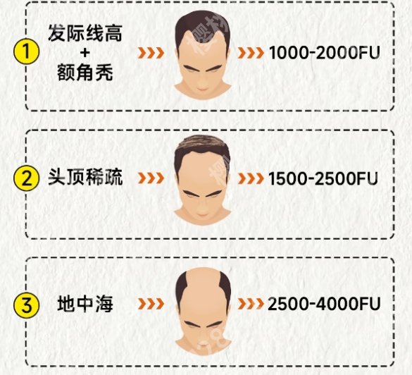 上海第二人民医院植发费用贵不贵?核心项目优势盘点!