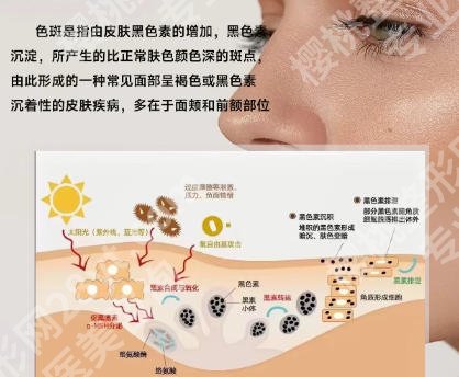 杭州浙一医院祛斑怎么样?技术怎么样?戳进来看!