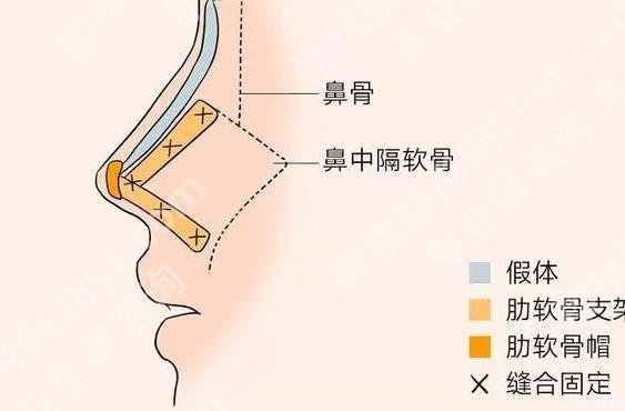 北医三院整鼻子怎么样?内附真人做隆鼻项目全流程!