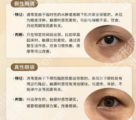 浙一割眼袋哪个医生好?沈向前、范希玲实力在线!值得信赖