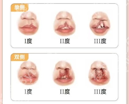山东省立医院正颌手术价格贵吗?全程费用一次性说清!就诊必看