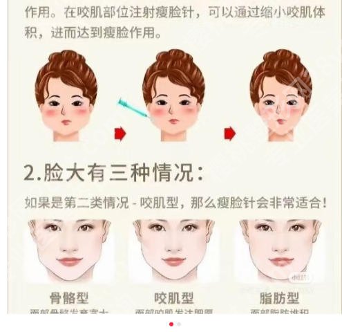 南昌哪里打瘦脸效果好?这几家医院技术在线实力不俗!
