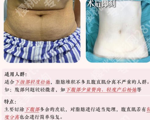江南大学附属医院腹壁整形专家公布!史高峰等医生技术沉稳,值得信赖!