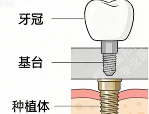 连云港满口种植牙多少钱?全口方案费用整理好了,花多少提前心里有数