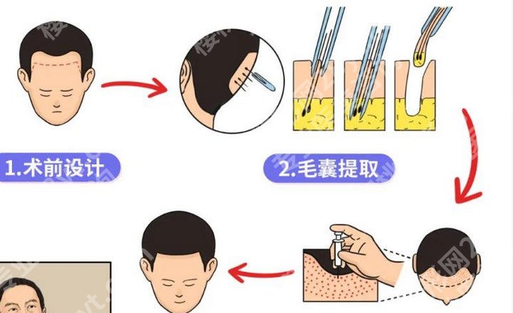 北京301医院植发多少钱一个毛囊?收费明细公布!透明收费更放心