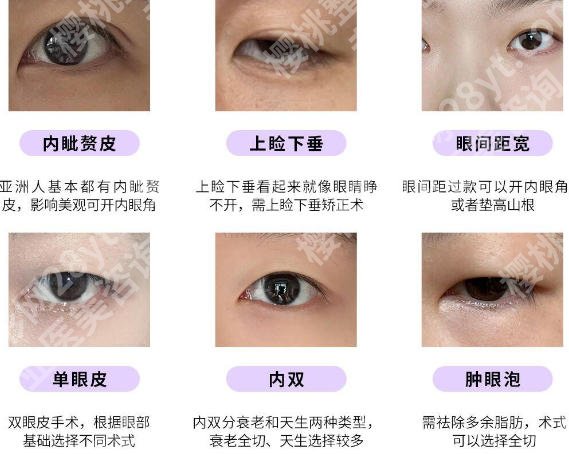 厦门排名前十双眼皮修复医院名单揭晓!top榜前十等你来看