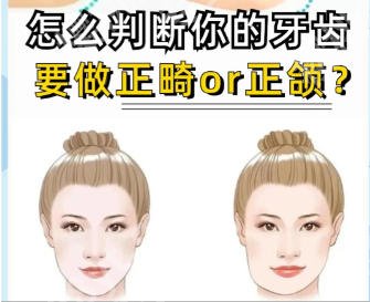 上海中山医院正颌手术价格贵不贵?正颌真实案例展示!