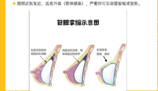 武汉协和医院隆胸多少钱?26年最新价格参考来啦